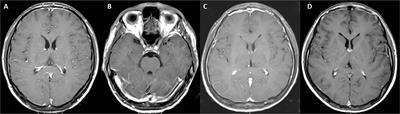Meningoencephalitis associated with GAD65 autoimmunity